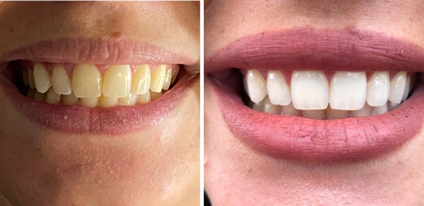 Top Teeth Whitening Products: An In-Depth Review